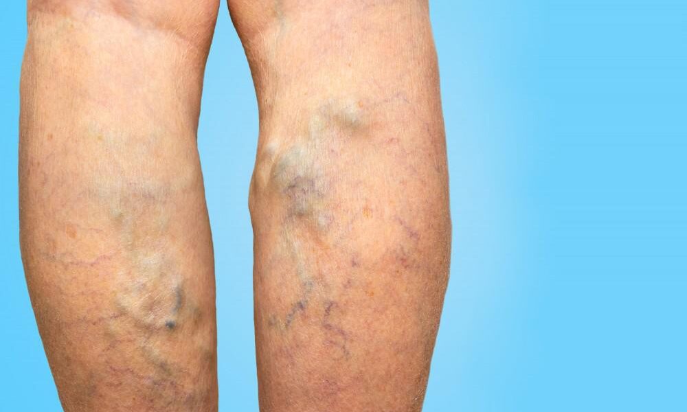 postpartum varicose veins