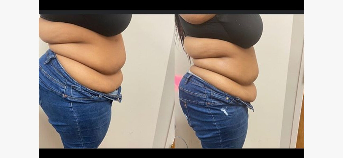 Lipo cavitation