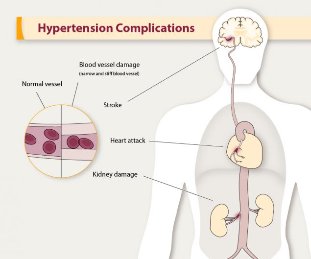 hypertension